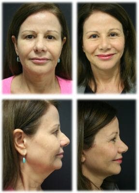 Facelift in Fort Lauderdale by Dr. Thomassen