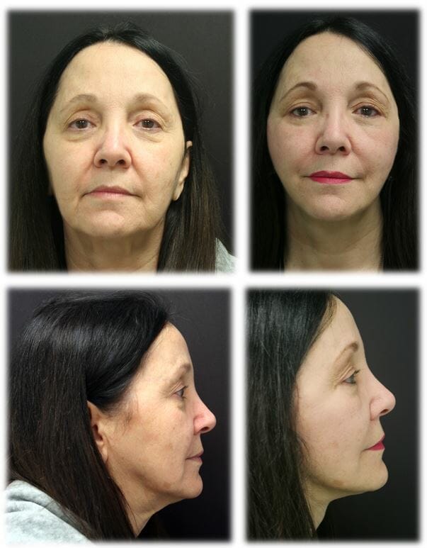 facelift before and after fort lauderdale