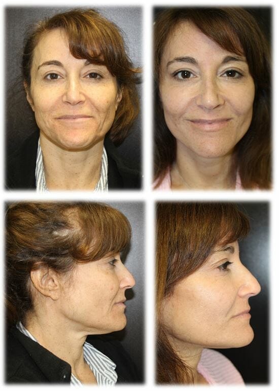facelift before and after fort lauderdale