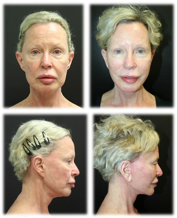 Facelift34 facelift before and after fort lauderdale