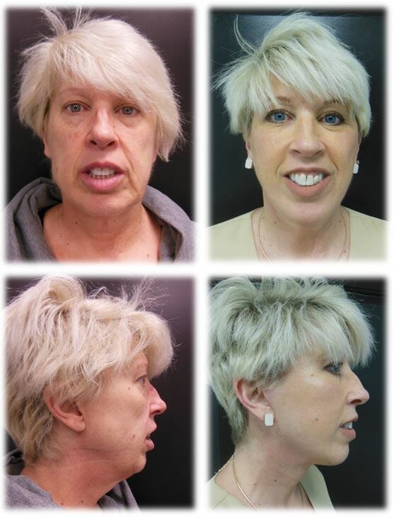 facelift before and after fort lauderdale