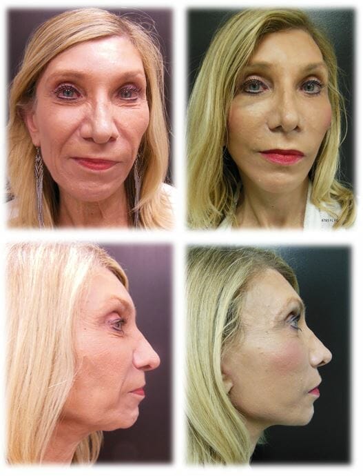Facelift in Fort Lauderdale by Dr. Thomassen