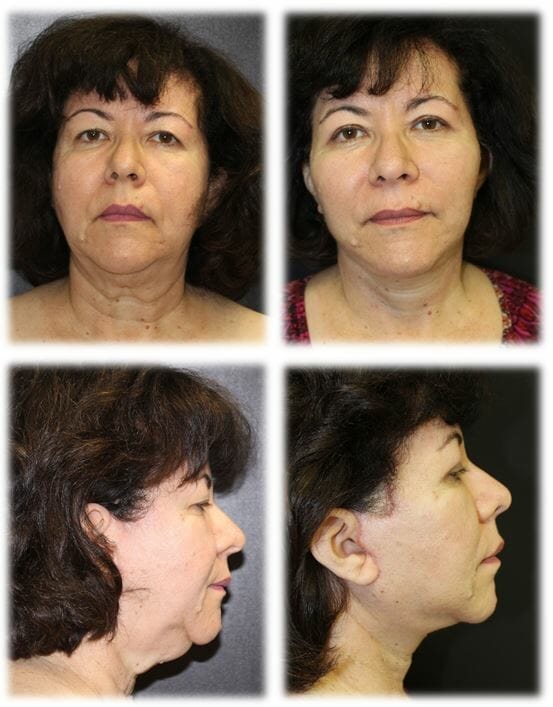 facelift before and after fort lauderdale