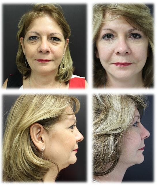 facelift before and after fort lauderdale