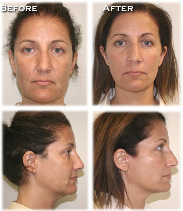 facelift before and after fort lauderdale