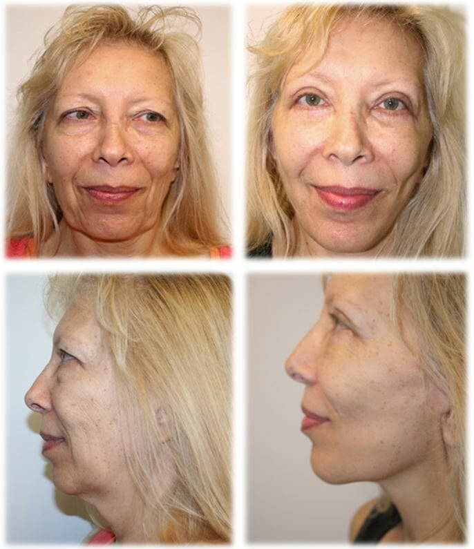 Facelift51 facelift before and after fort lauderdale