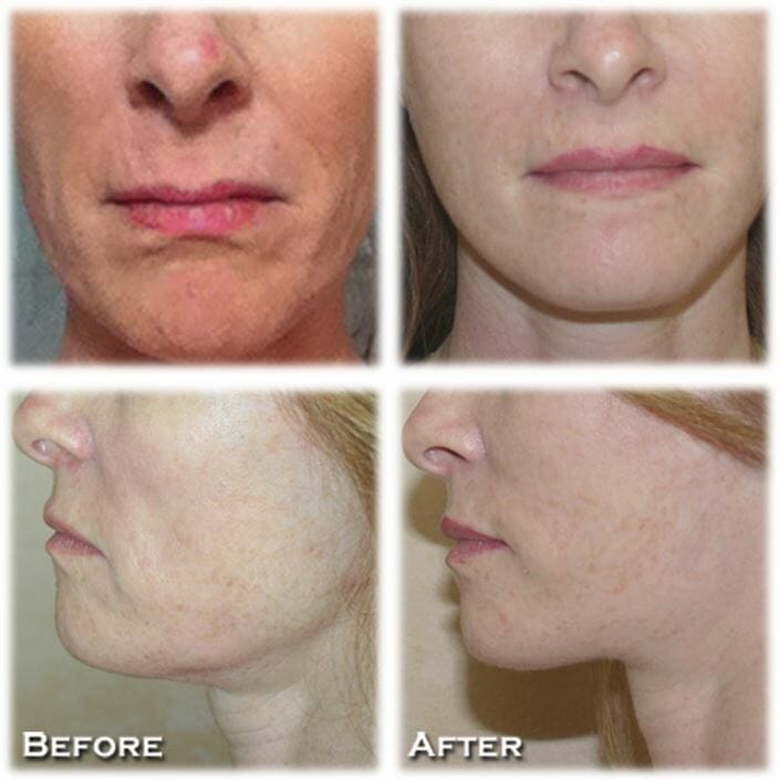 Facelift52 facelift before and after fort lauderdale