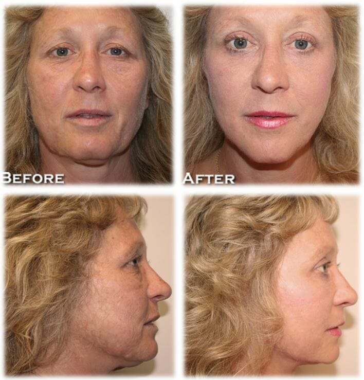 facelift before and after fort lauderdale