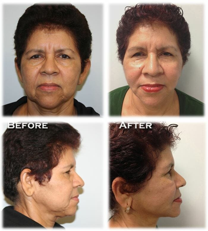 Facelift62 facelift before and after fort lauderdale