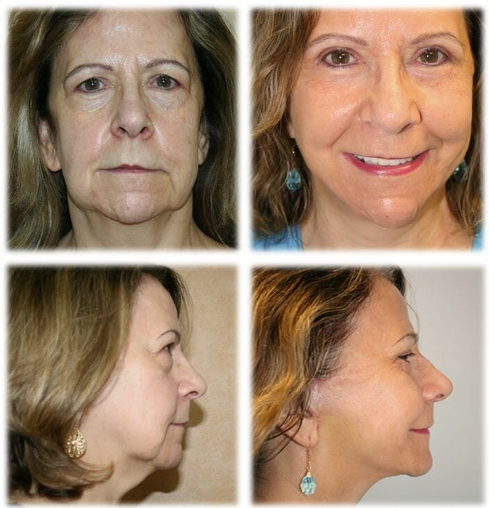facelift before and after fort lauderdale