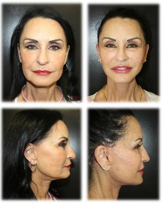 Facelift in Fort Lauderdale by Dr. Thomassen