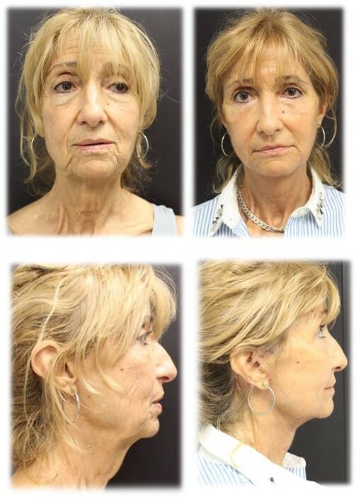 Face and Neck Lift and Fat grafting by Dr. Thomassen in Fort Lauderdale