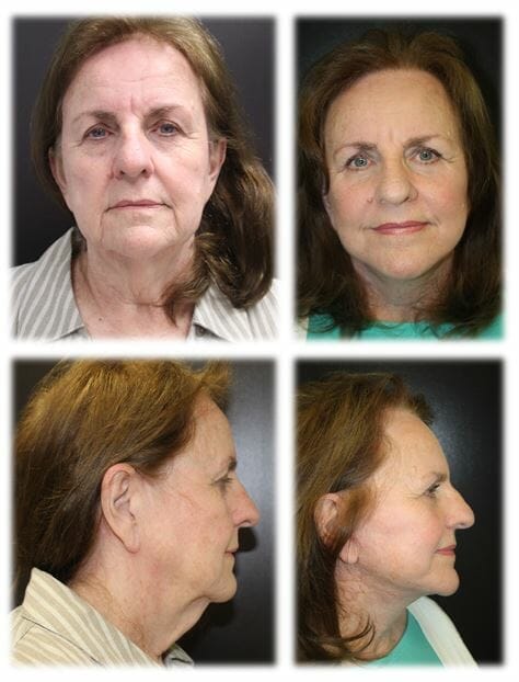 facelift before and after fort lauderdale