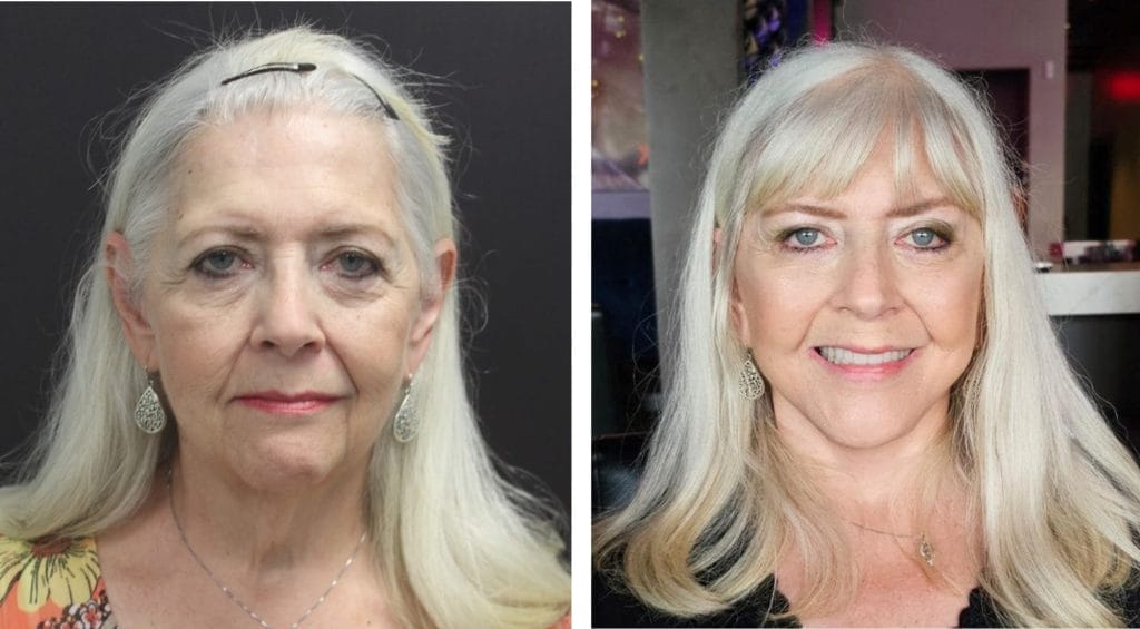 facelift before and after fort lauderdale