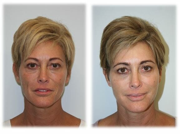 Facial Fat Grafting by Dr. Thomassen