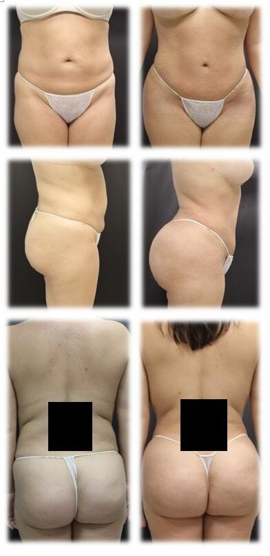 Fat Grafting to Buttock (Brazilian Butt Lift) Results: Before and