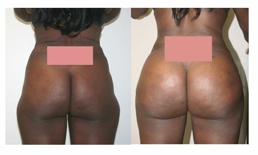 Brazilian Butt Lift by Dr. Thomassen