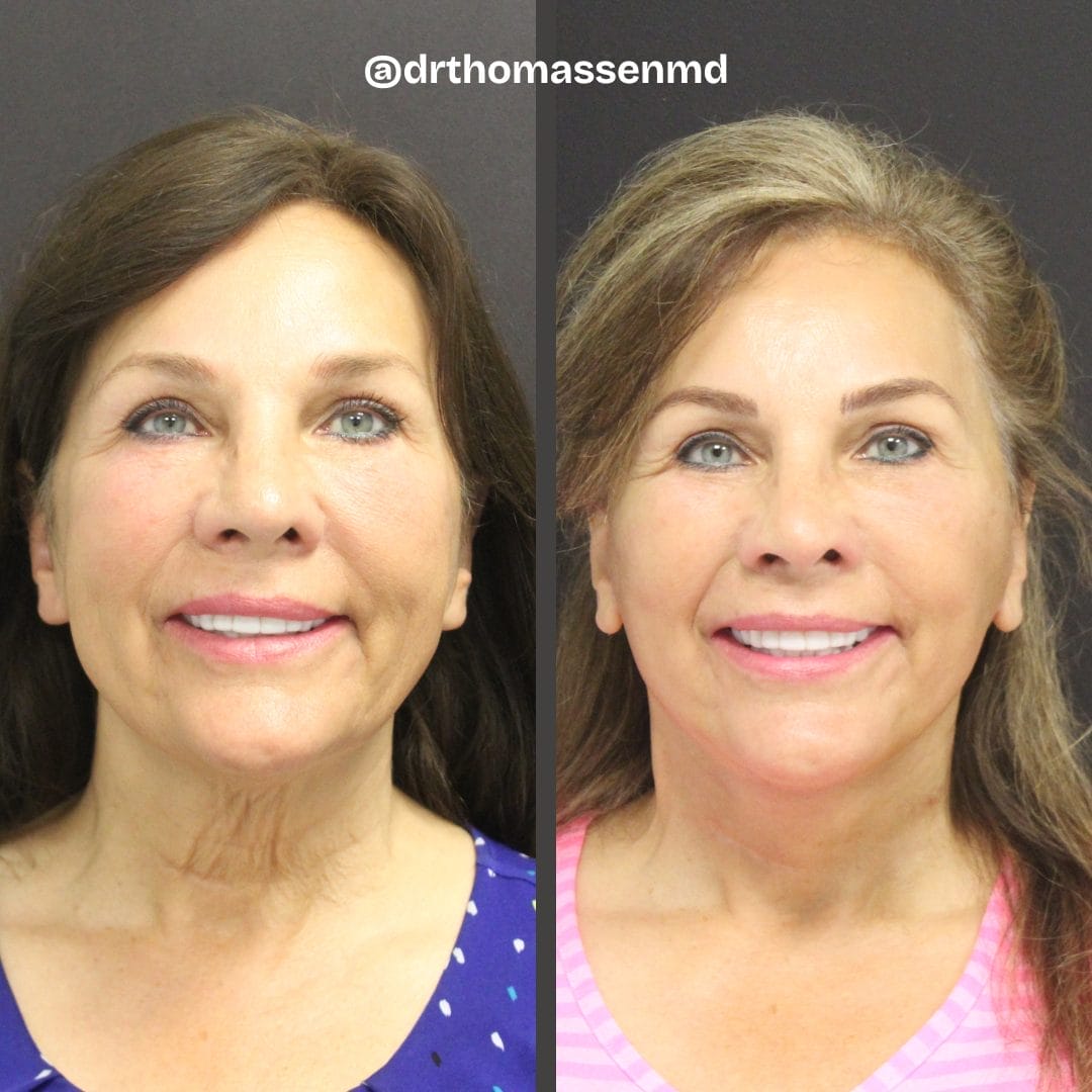Facelift 5 Face and Neck lift before and after by Dr. Thomassen in Fort Lauderdale
