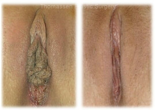 Labiaplasty by Dr. Thomassen
