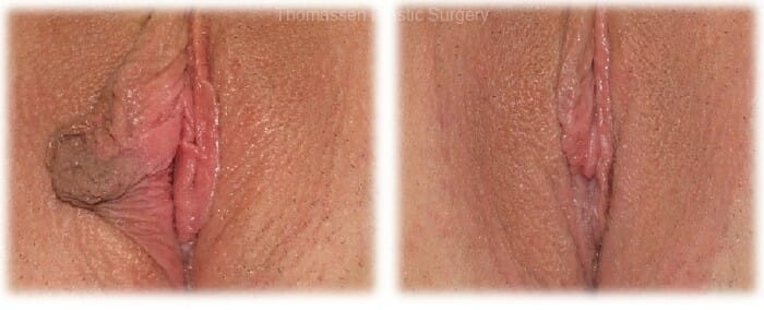 Labiaplasty by Dr. Thomassen