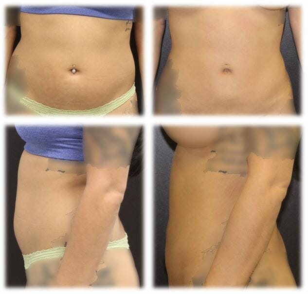 Liposuction Result by Dr. Thomassen