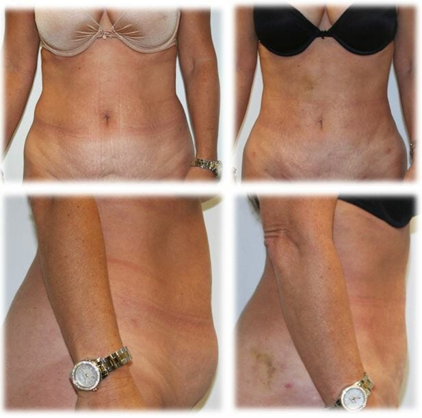 Liposuction11 Liposuction Result by Dr. Thomassen