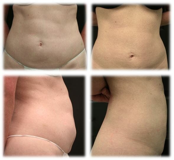 Liposuction13 Liposuction Result by Dr. Thomassen