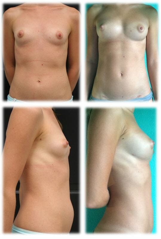 Liposuction14 Liposuction Result by Dr. Thomassen