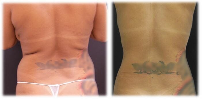 Liposuction15 Liposuction Result by Dr. Thomassen