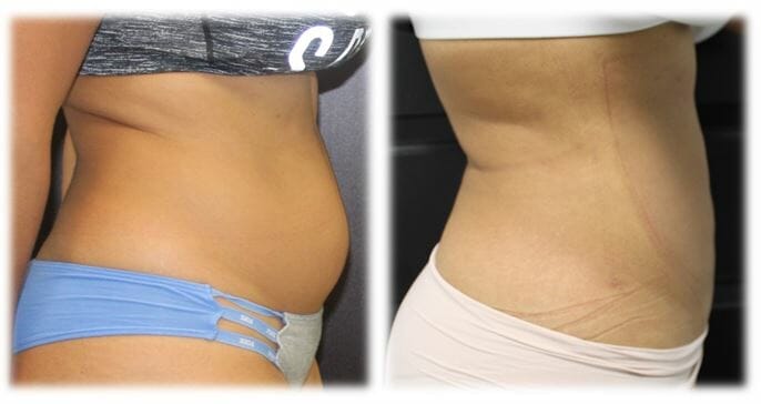 Liposuction16 Liposuction Result by Dr. Thomassen