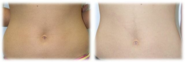 Liposuction17 Liposuction Result by Dr. Thomassen