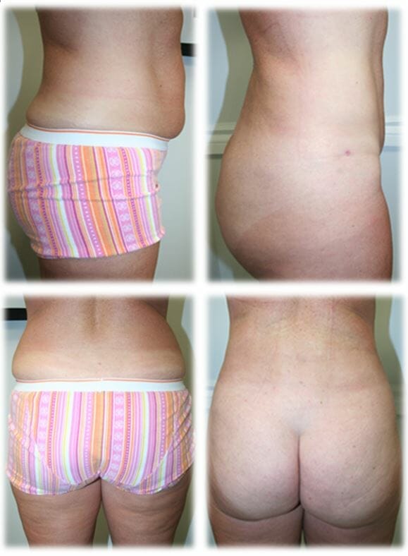 Liposuction18 Liposuction Result by Dr. Thomassen