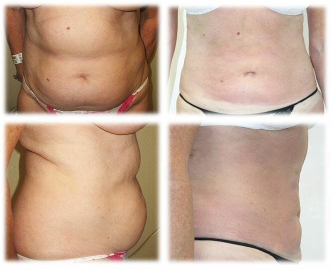 Liposuction19 Liposuction Result by Dr. Thomassen