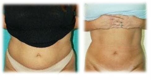 Liposuction20 Liposuction Result by Dr. Thomassen