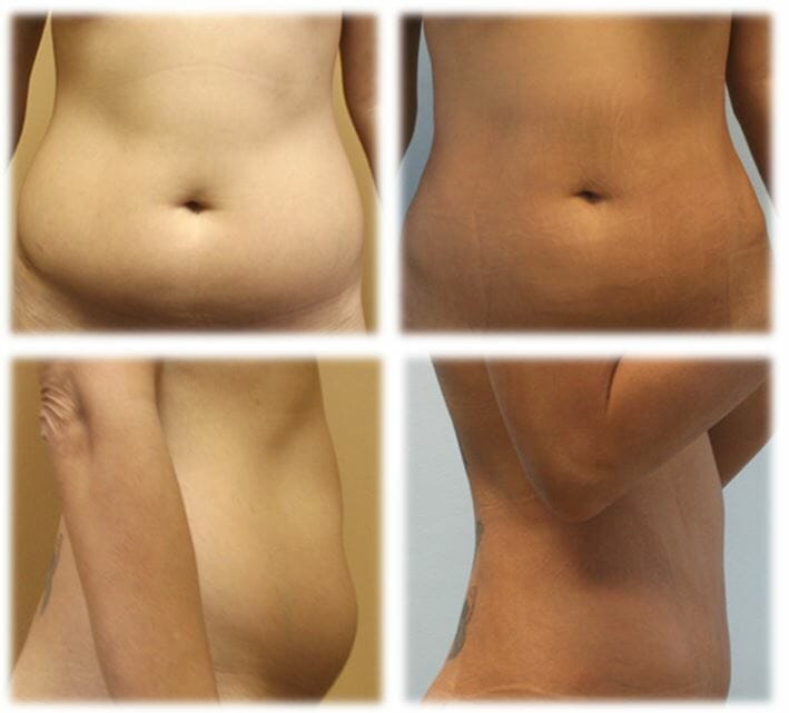 Liposuction21 Liposuction Result by Dr. Thomassen