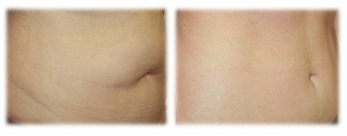 Liposuction22 Liposuction Result by Dr. Thomassen