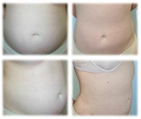 Liposuction24 Liposuction Result by Dr. Thomassen