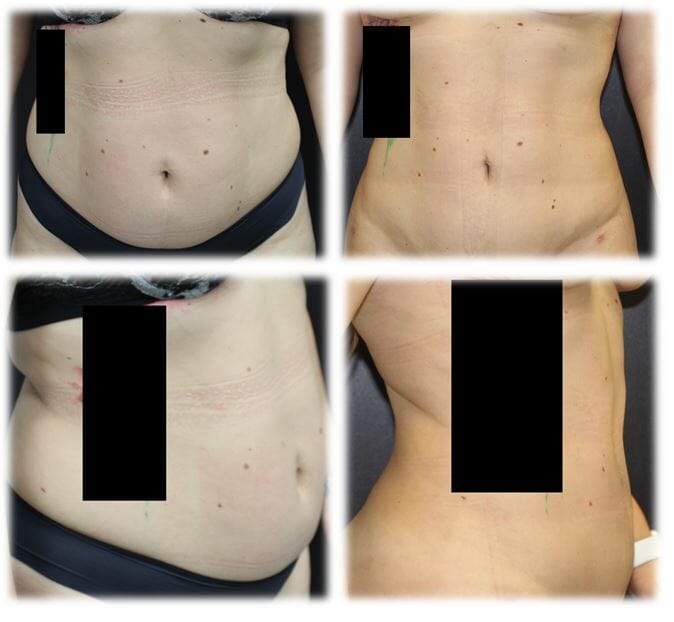 Liposuction26 Liposuction Result by Dr. Thomassen