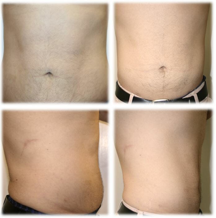 Liposuction Result by Dr. Thomassen