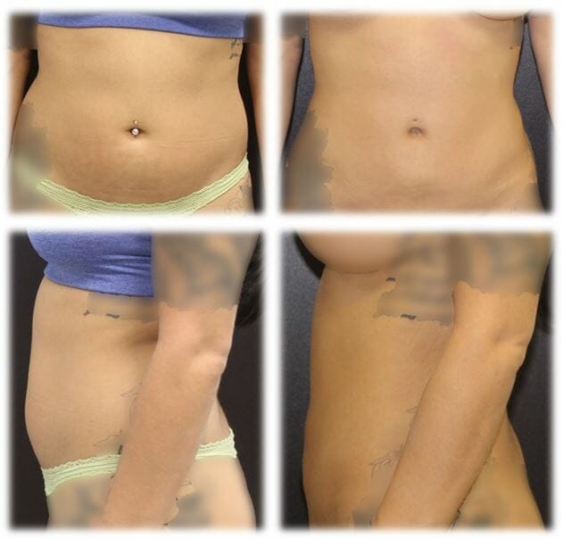 Liposuction Result by Dr. Thomassen