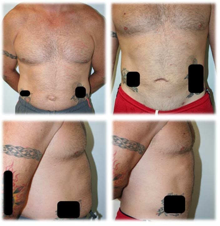 Liposuction Result by Dr. Thomassen