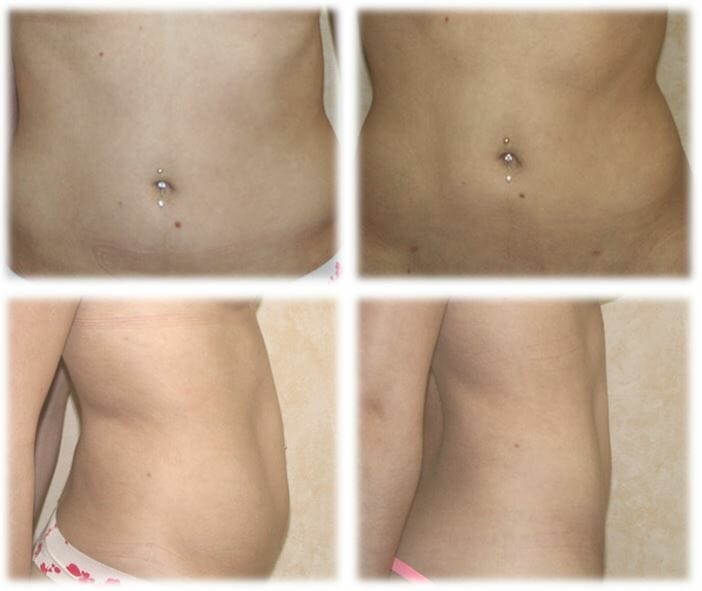 Liposuction Result by Dr. Thomassen