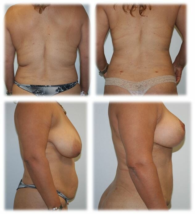 Liposuction Result by Dr. Thomassen