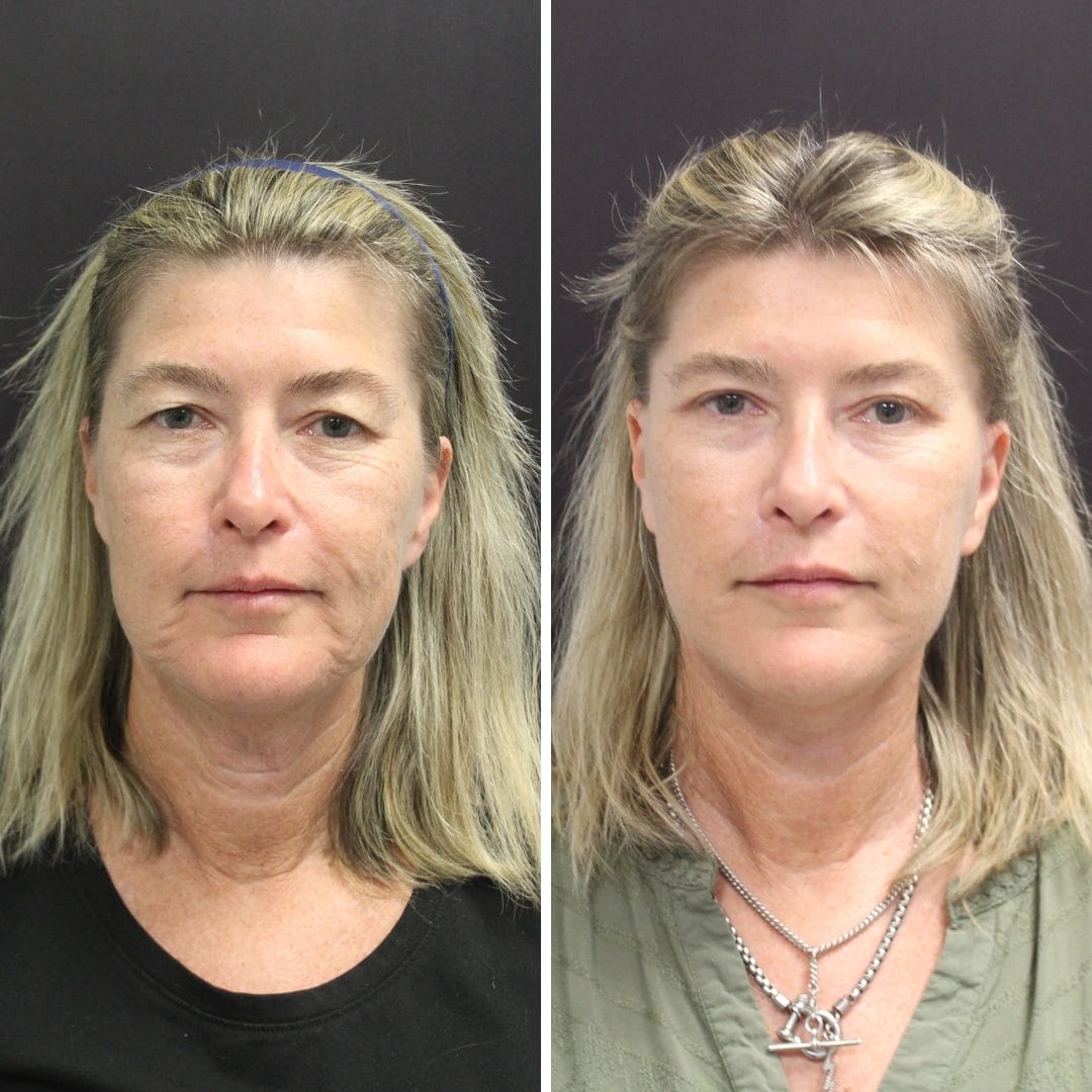 Facelift 4 Mini facelift before and after by Dr. Thomassen in Fort Lauderdale