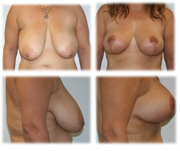 Mastopexy by Dr Thomassen