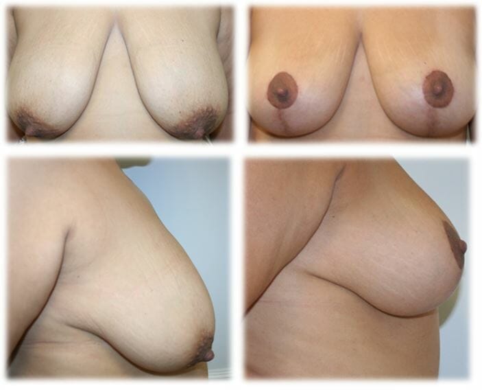 Mastopexy by Dr Thomassen