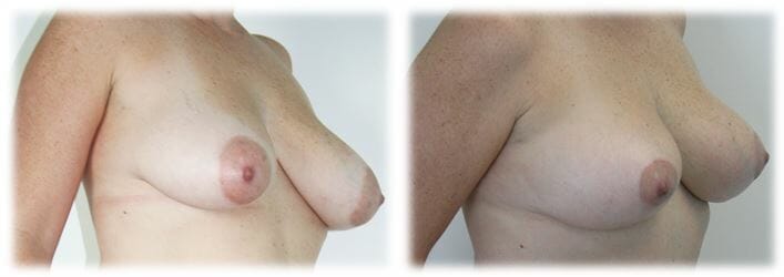 Mastopexy16 Mastopexy by Dr Thomassen