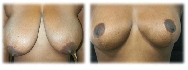 Mastopexy2 Mastopexy by Dr Thomassen