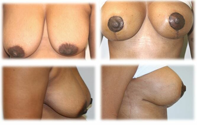 Mastopexy24 Mastopexy by Dr Thomassen