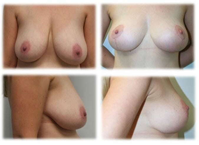 Mastopexy by Dr Thomassen